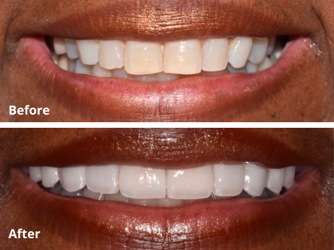 Veneers before after